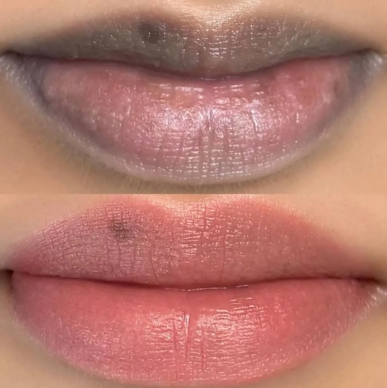 How to Reduce Swelling After Lip Neutralization